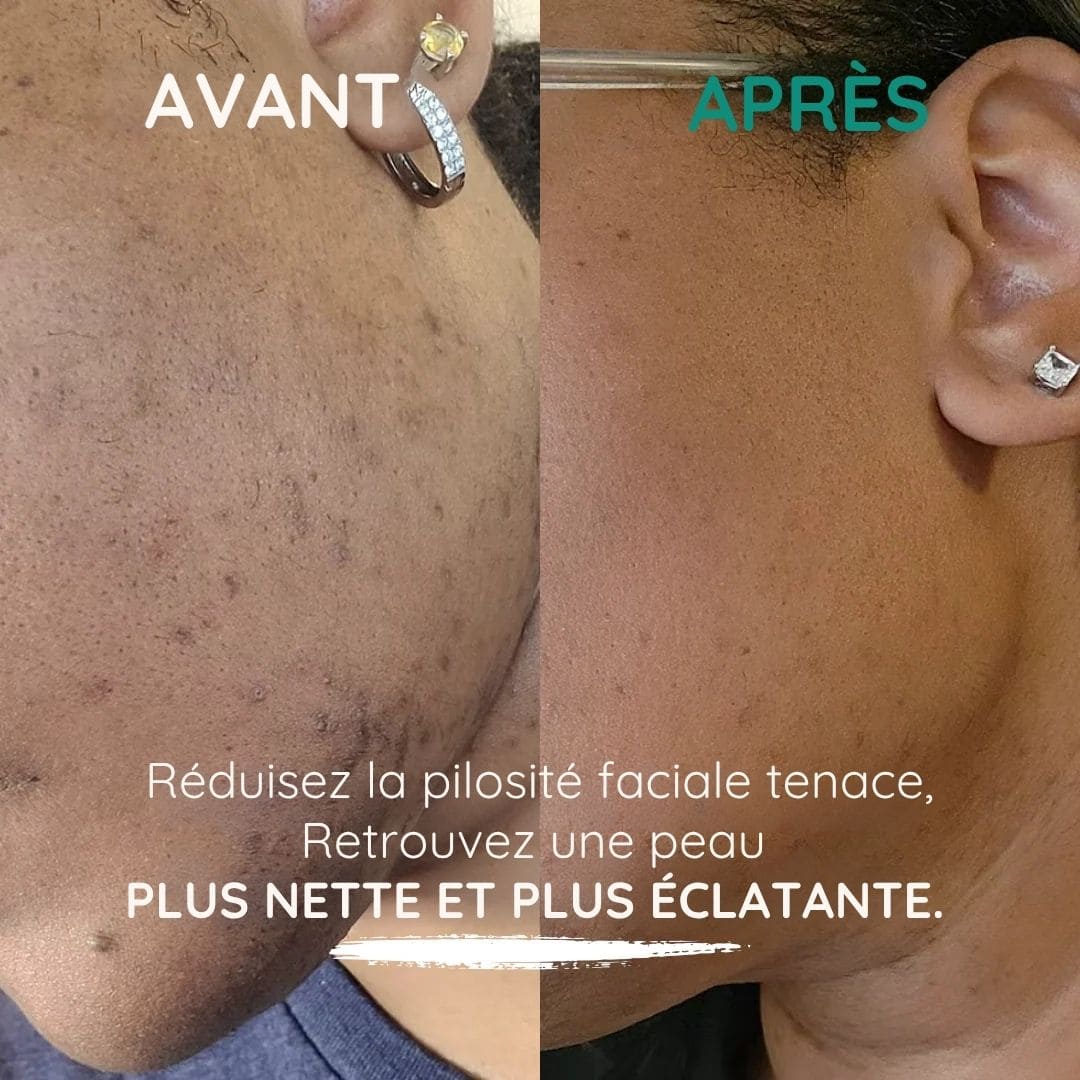 SOPK Balance+ / Équilibre Hormonal, Cycles Réguliers et Peau Plus Nette